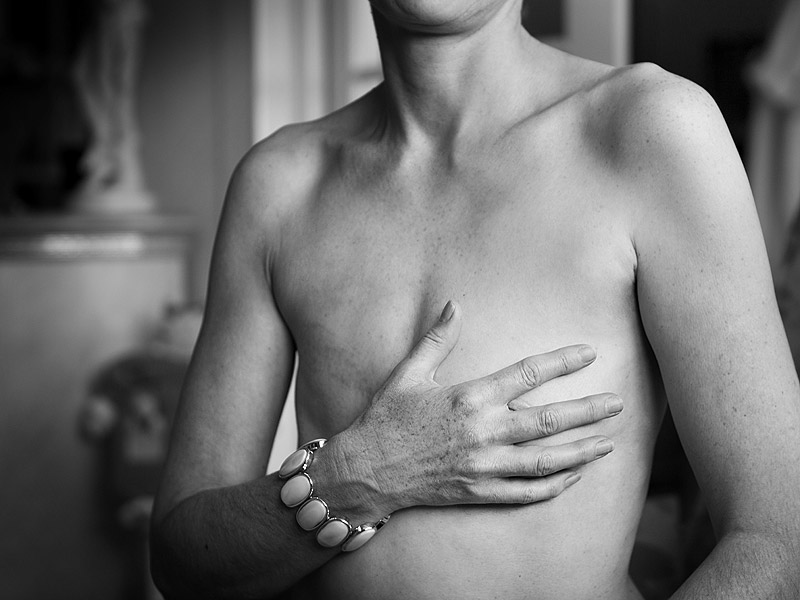mastectomy myths- Netmarkers