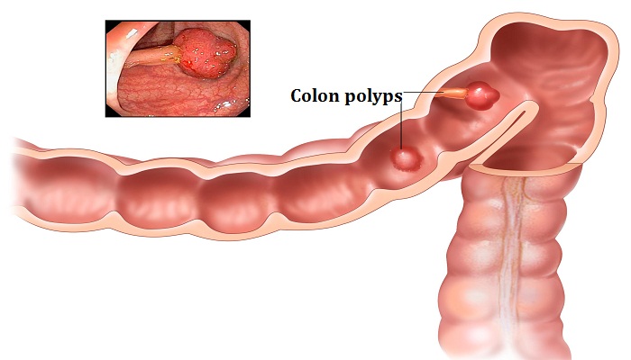 colon cancer-Netmarkers