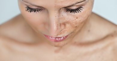 top home remedies for hyperpigmentation- Netmarkers