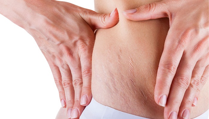 Home-Remedies-for-Stretch-Marks-Netmarkers