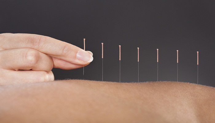 acupuncture-Netmarkers