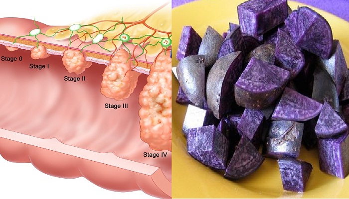colon-cancer-Purple potatoes-Netmarkers