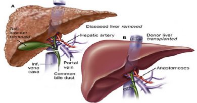 Liver Transplant- Netmarkers