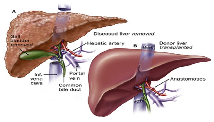 Liver Transplant- Netmarkers