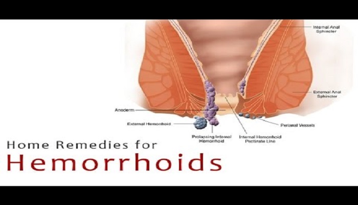 top-ten-home-remedies-for-hemorrhoids-piles-netmarkers