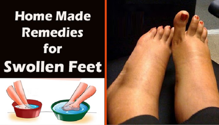 swollen-feet-remedies-netmarkers