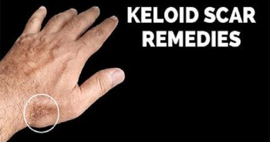 keloids-and-scars-netmarkers