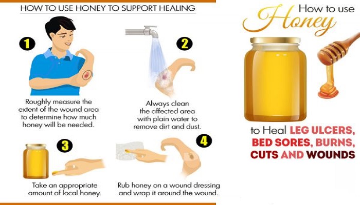 use-honey-to-heal-burns-cuts-wounds-and-bed-sores-netmarkers