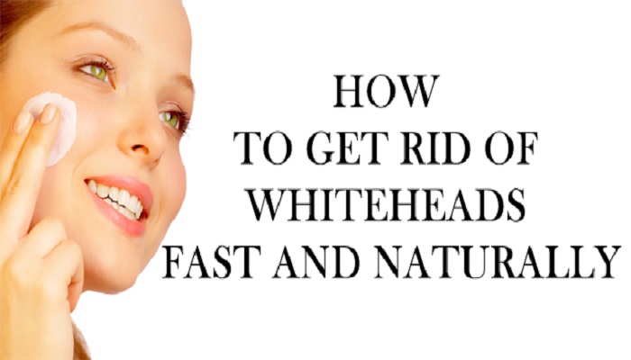 how-to-get-rid-of-whiteheads-netmarkers