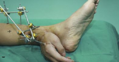 severed-hand-implanted-to-leg-before-reattachment-netmarkers