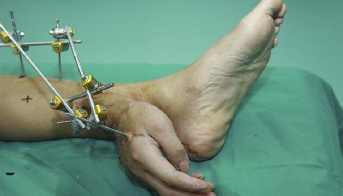 severed-hand-implanted-to-leg-before-reattachment-netmarkers