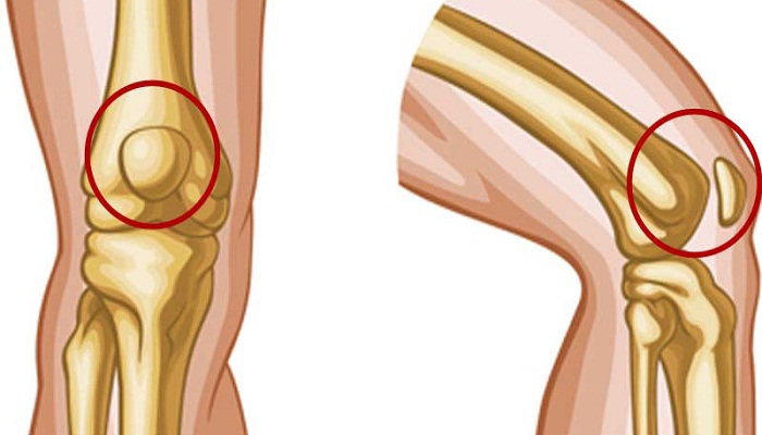knee-pain-netmarkers