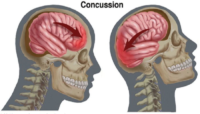 concussion-brain-netmarkers