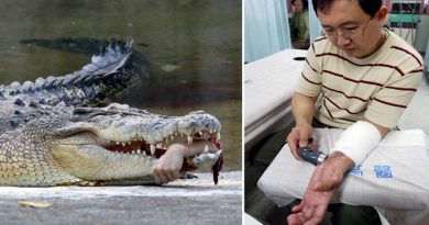 Reattachment of Forearm After Crocodile Attack netmarkers